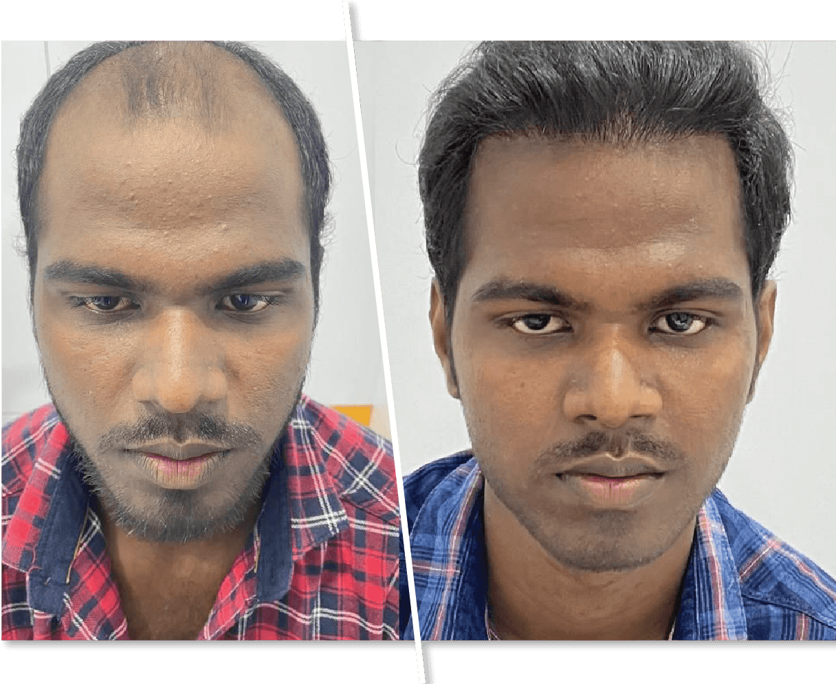 Hair Re-Growth & Hair fall Treatment in Hyderabad: Kolors