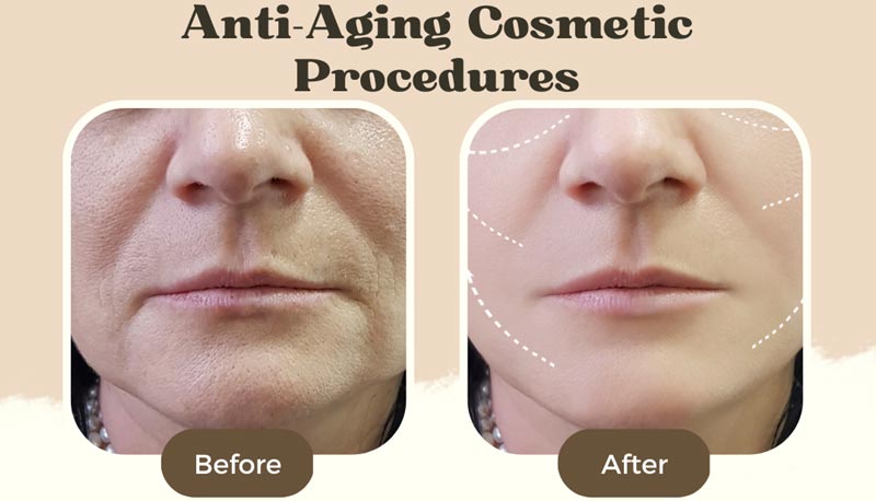 https://www.kolorshealthcare.com/blog/wp-content/uploads/2023/02/Anti-Aging-Cosmetic-Procedures-Women-Before-After.jpg