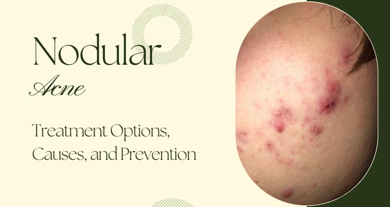 What Is a Skin Lump? Symptoms, Causes, Diagnosis, Treatment, and Prevention